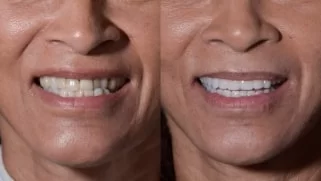 x dentistry snap on denture patient before after 05