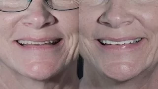 x dentistry snap on denture patient before after 06