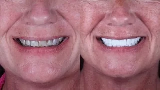 x dentistry snap on denture patient before after 07