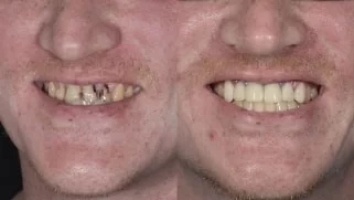 x dentistry snap on denture patient before after 08
