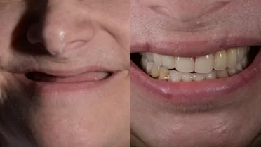 x dentistry snap on denture patient before after 03