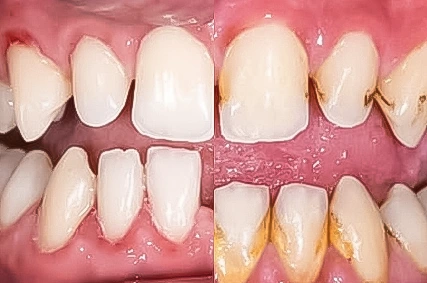 x dentistry crowns after 03
