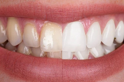 x dentistry prices cleaning 02