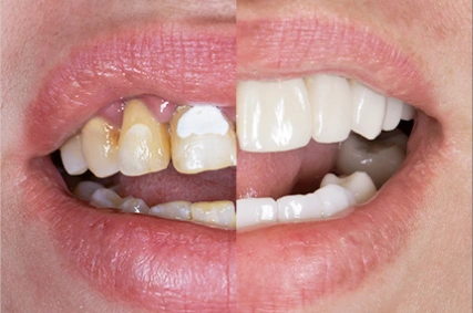 x dentistry prices cleaning 01