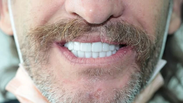 x dentistry whitening before after 01
