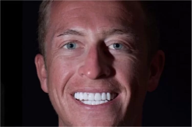 x dentistry teeth whitening after patient 01