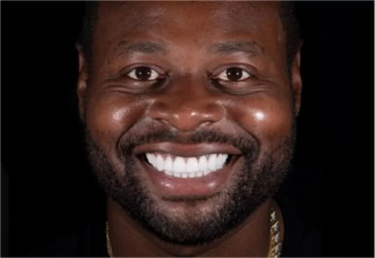 x dentistry teeth whitening after patient 02