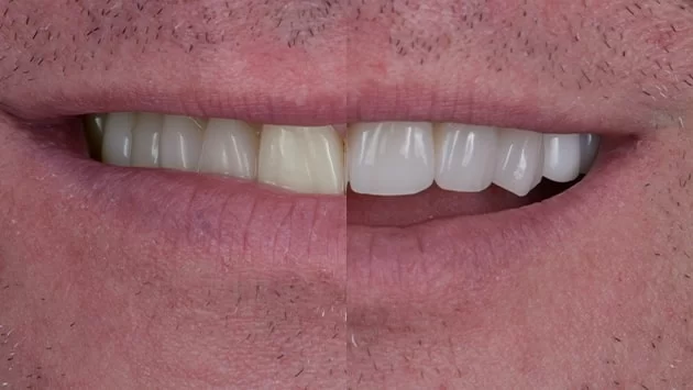 x dentistry teeth whitening patient before after 02