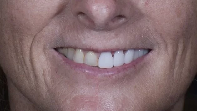 x dentistry teeth whitening patient before after 03