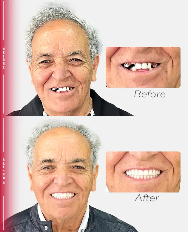 dental patient smiling pointing tijuana