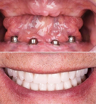 all on 4 super structure