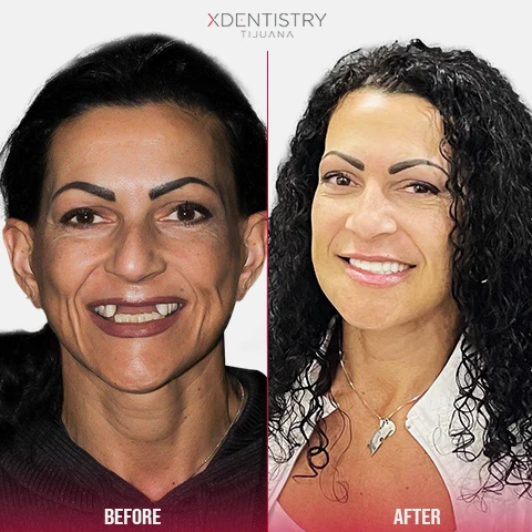 all on 4 patient xdentistry tijuana 04