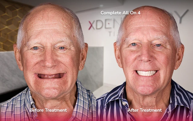 before after all on 4 tijuana xdentistry 01