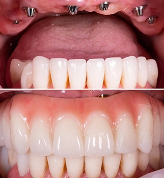 all on 6 dental implants tijuana