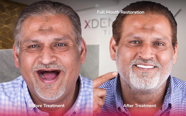 before after all on 4 tijuana xdentistry 02