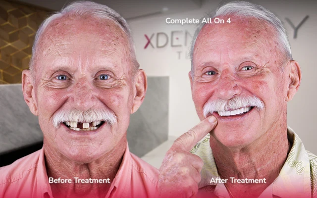 before after all on 4 tijuana xdentistry 03